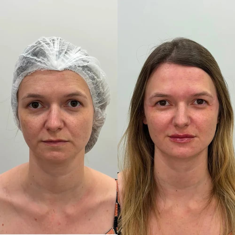 Resultado de tratamento facial realizado pela Dra. Josi — caso 1