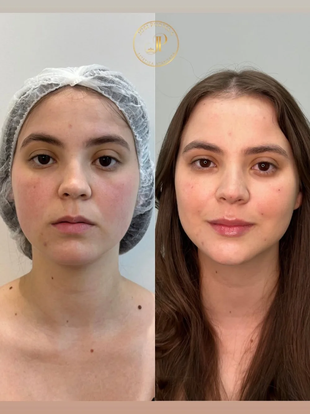 Resultado de tratamento facial realizado pela Dra. Josi — caso 3